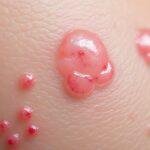 découvrez notre guide complet pour reconnaître l'herpès génital. apprenez à identifier les symptômes grâce à des photos explicites et des conseils pratiques pour mieux comprendre cette infection et en parler avec votre professionnel de santé.